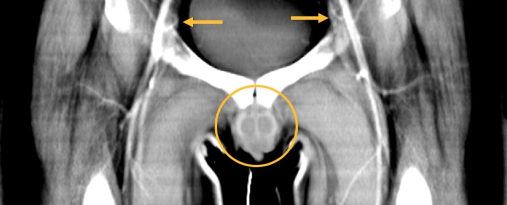 penis transplant 阴茎移植